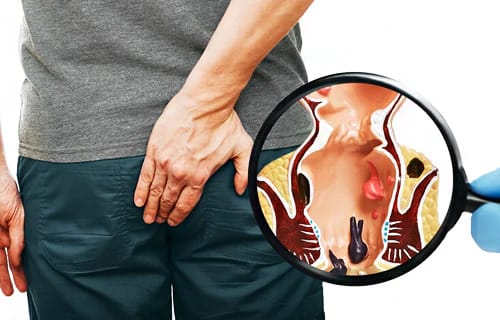 Piles Hemorrhoids Medical Illustration